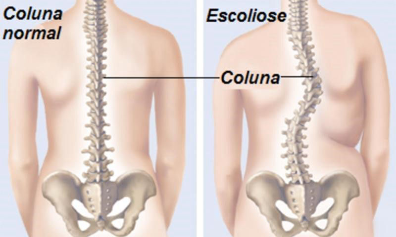 Desvios de coluna vertebral