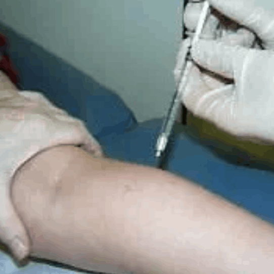 Paralisia cerebral - tratamentos